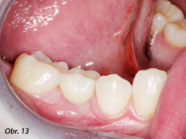 Definitivní náhrada v ústech pacientky.