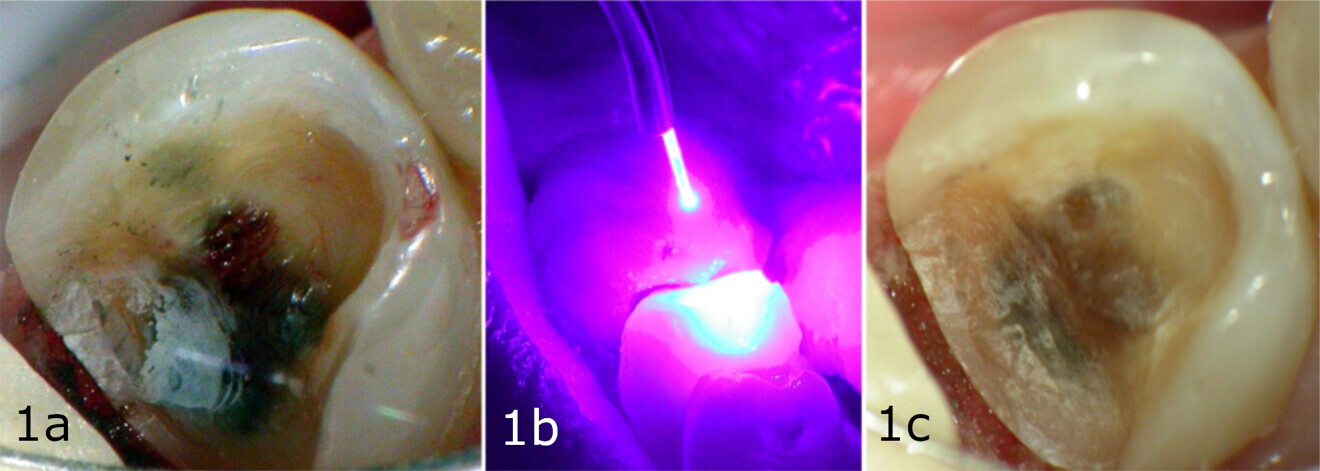 Figs. 1a–c: Example of laser treatment for the removal of residual caries after cavity preparation with standard burs. Caries noted on the pulpal floor and small pulpal exposure (a). Utilisation of the Nd:YAG laser (b). Resulting preparation floor ready for placement of a direct resin restoration (c).