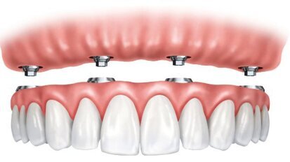 Le marché de la prothèse amovible supra-implantaire en France