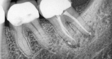 השפעת הארכת כותרת על שרידות שיניים אחוריות עם טיפול שורש כעבור עשר שנים