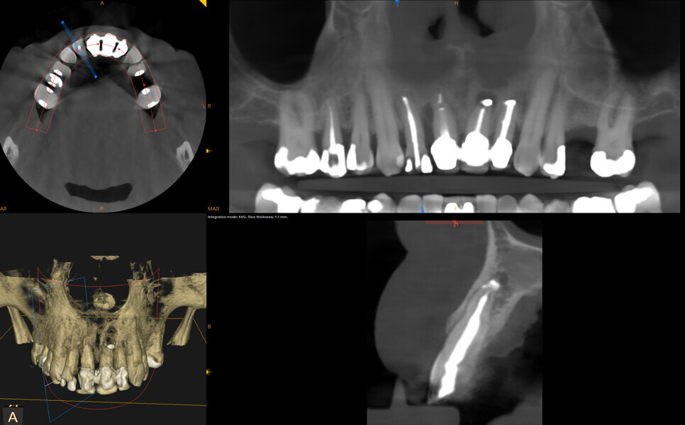 Fig. 2: Initial CBCT scan of the maxillary arch.