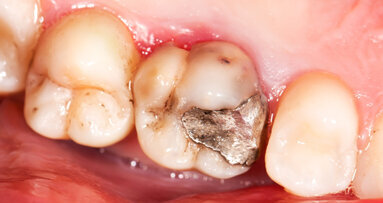 Studie zur Haltbarkeit von Restaurationen