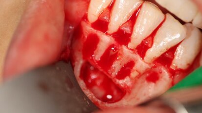 Leczenie chirurgiczne torbieli żuchwy – opis przypadków