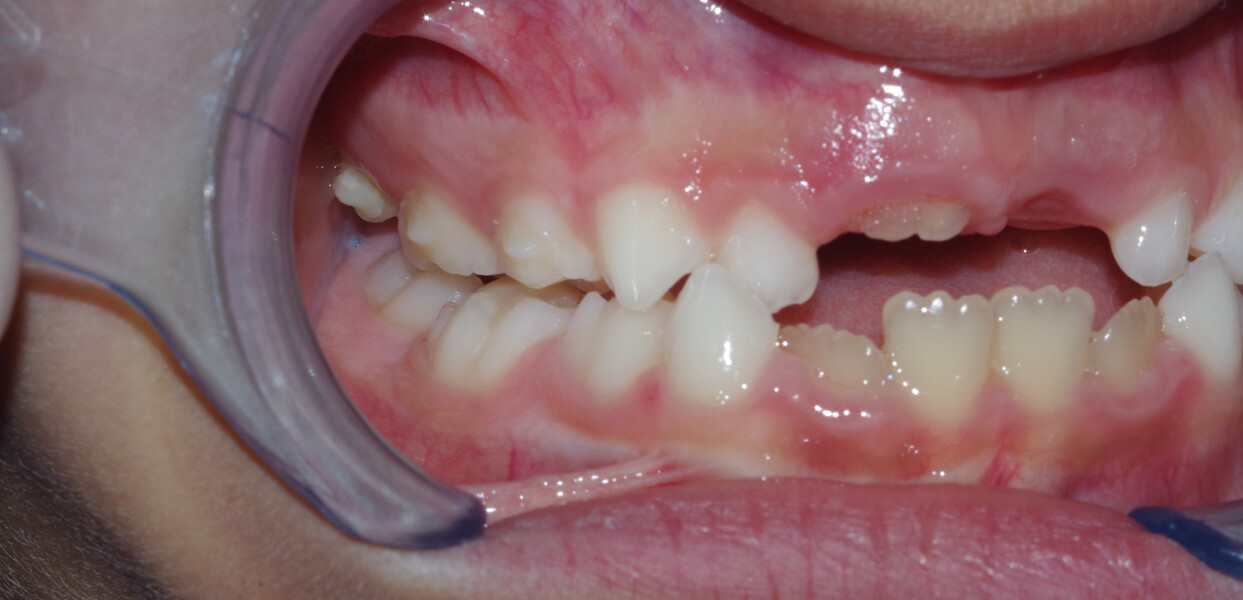 Fig. 7a: Final photographs: right lateral view.