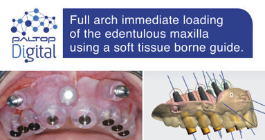 Full arch immediate loading of the edentulous maxilla using a soft tissue borne guide.