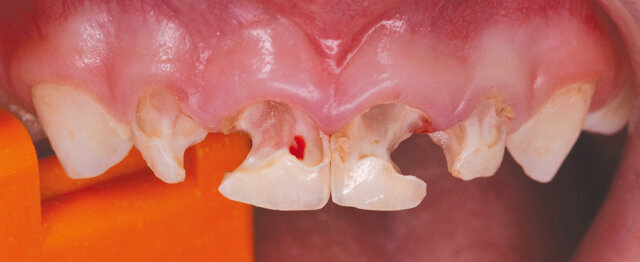 Horní řezáky po exkavaci