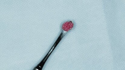 Cellules souches en implantologie