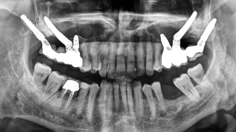 Rehabilitace unilaterální maxilární bezzubosti