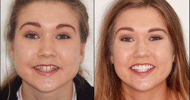 A combined digital orthodontic and restorative approach