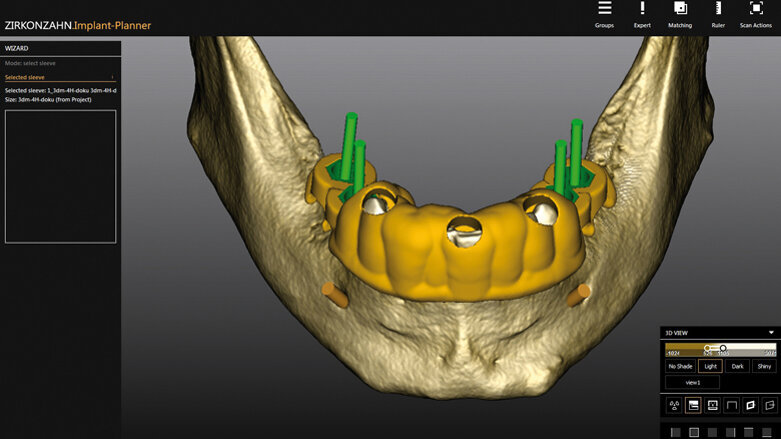 Nová řešení v programech Zirkonzahn: Perfektní v digitálním zpracování