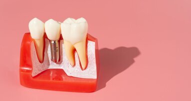 Onderzoek toont risicofactoren voor vroegtijdig implantaatfalen