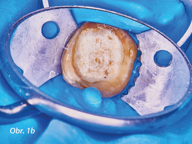 Řešení endodontických selhání