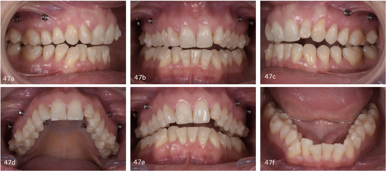 Figs. 47a–f: Attachments and micro-screws placed.