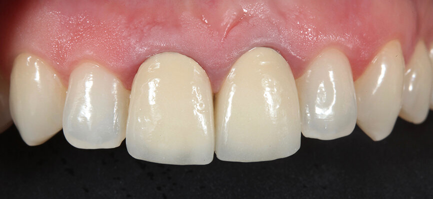 Fig. 15a. Vista frontal que muestra la conseguida estética de la restauración.