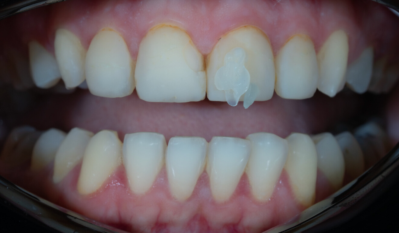 Fig. 2: Shade determination image taken with the aid of a cross-polarising filter that eliminates reflections.