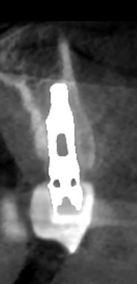 Fig. 6b, 6c - Le sezioni alla Cone beam mostrano il mantenimento volumetrico dell’osso alveolare.