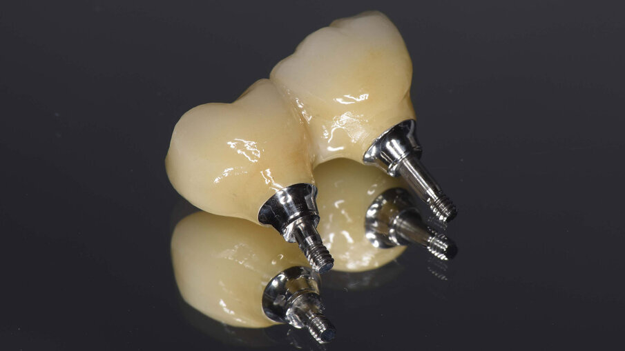 Figg. 18a, 18b_Elementi definitivi in zirconio avvitati.