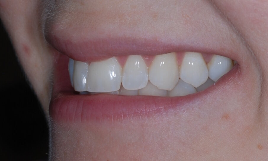 Fig. 17: Post treatment left lateral