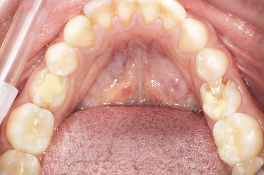 Fig. 4_L’arcata inferiore.