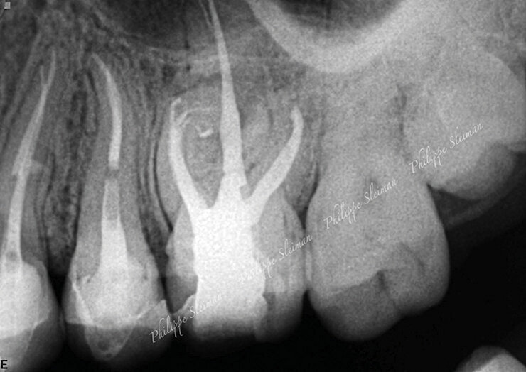 Slučaj 3 – Slika br. 9: Periapikalni kontrolni Rtg snimak odmah nakon tretmana