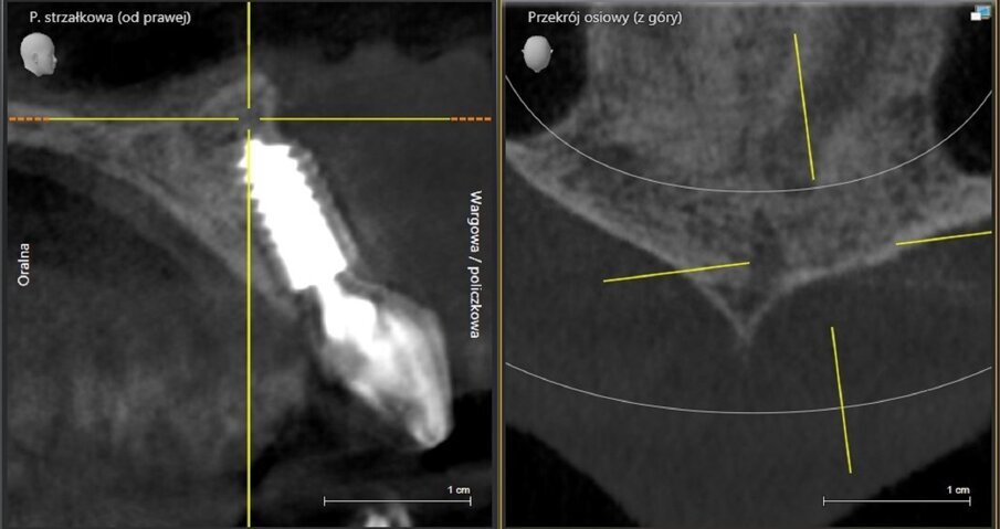 Fig. 19: CBCT scan 1.5 years post-op. Visible bone regeneration.