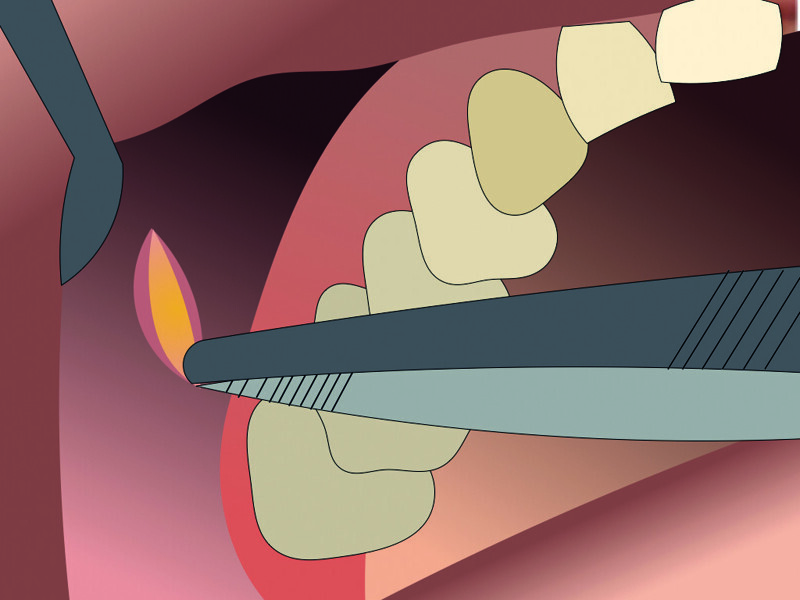 Fig. 12 : Traction du corps adipeux de la joue.