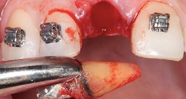 Cómo lograr cirugías exitosas y evitar complicaciones