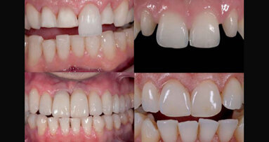 Indicaciones para la selección de cerámicas