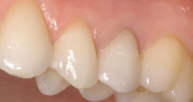 Computer-aided crown design – Fabrication of CAD/CAM crowns chairside