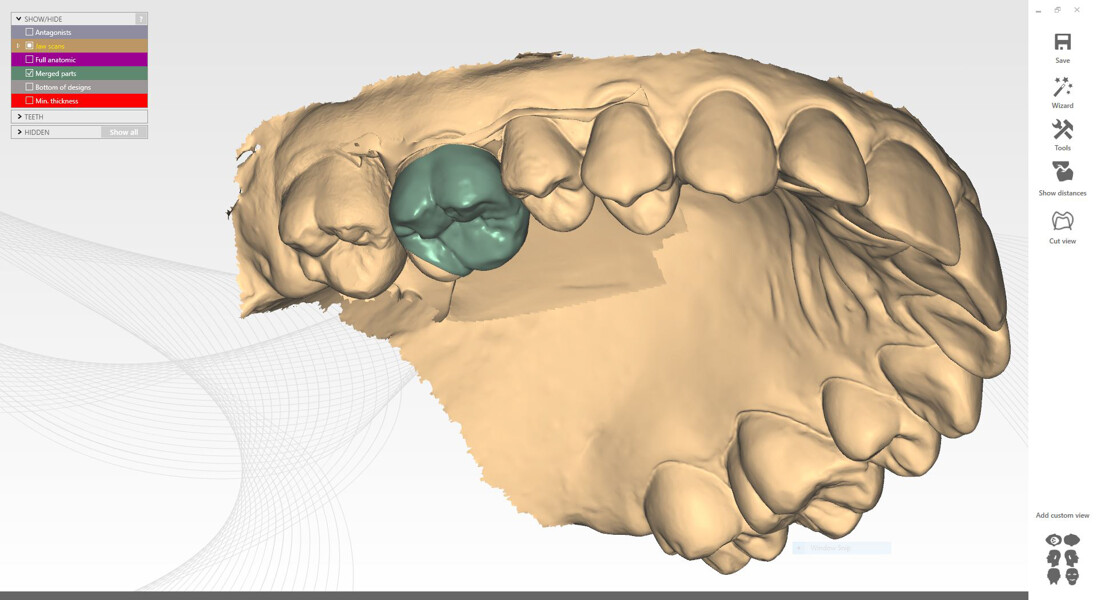 Fig. 17c: Digital workflow for the onlay design. On the virtual maxillary model (oblique occlusal view).