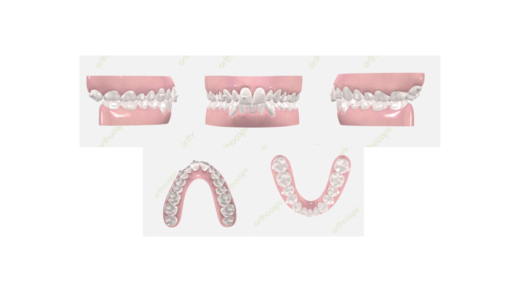 Figs. 16–20: Digital set-up of the intended treatment result.