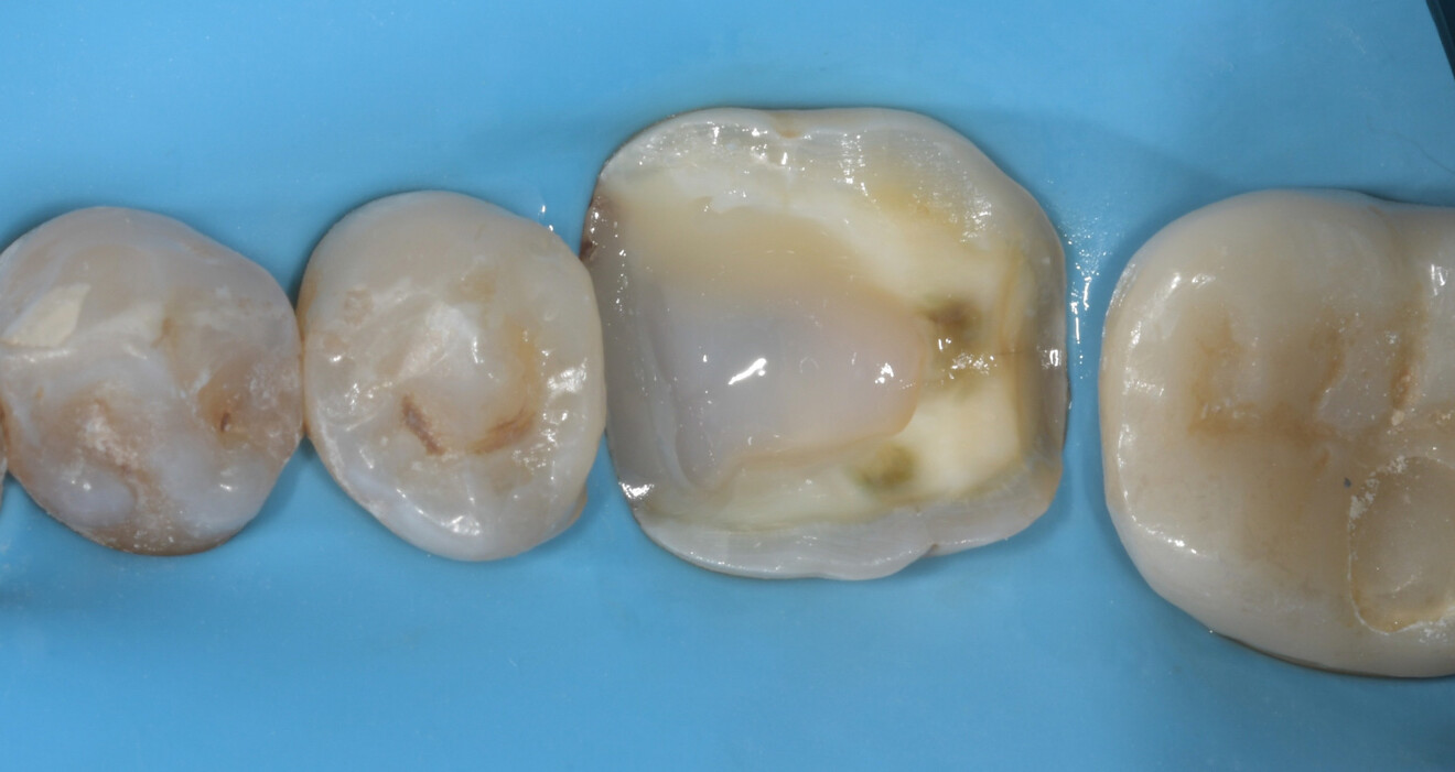 Fig. 23: Tooth #36 after etching and application of a universal adhesive.