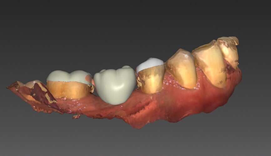 Ryc. 29-32_Projekt korony tymczasowej przykręcanej