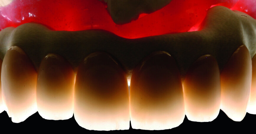 Fig. 26: Transparency of the final restoration.