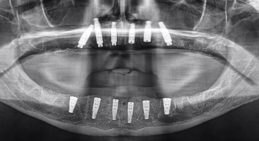 Fig. 17: Post-op panoramic radiograph revealing the successful placement of 12 implants in a two-stage protocol, requiring a healing period of three to four months before uncovering.