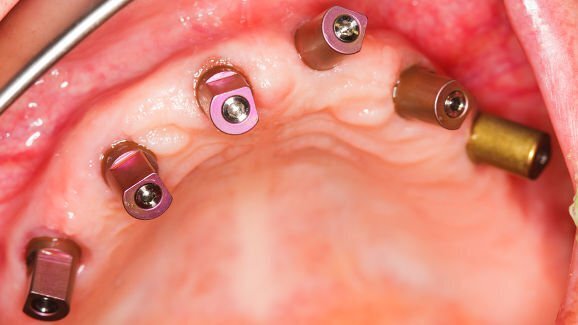 Nova nanotecnologia poderá melhorar a restauração óssea dos pacientes na Odontologia