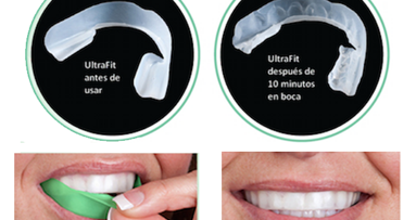 Opalescence Go, la evolución del blanqueamiento