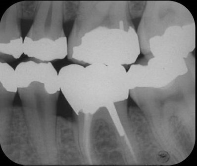 Afb. 6: Volledige gouden kroon geplaatst op de 36