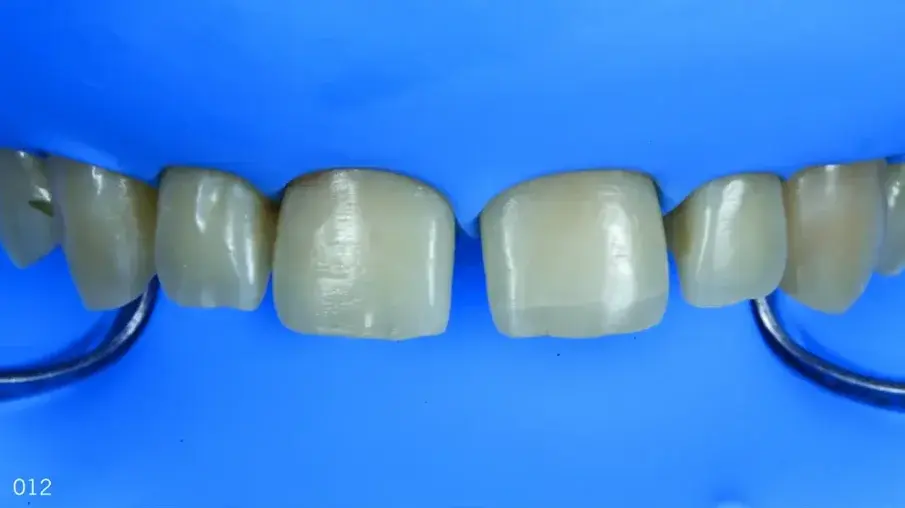 Фиг. 11 Изолиране на оперативното поле с помощта на кофердам, фронтален изглед.