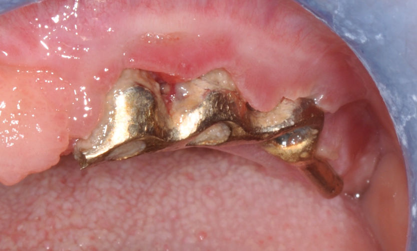 Fig.5: Implant bar with abundant plaque deposits and evident mucositis.