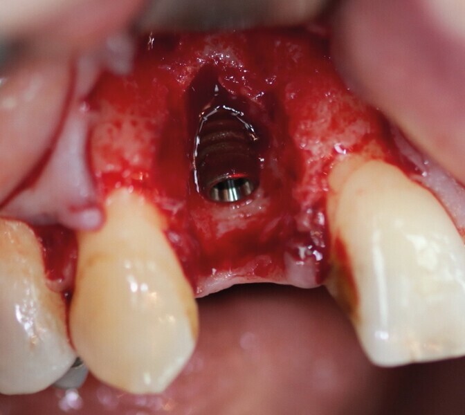 Fig. 26 : Implant cylindroconique avec un excellent ancrage. 