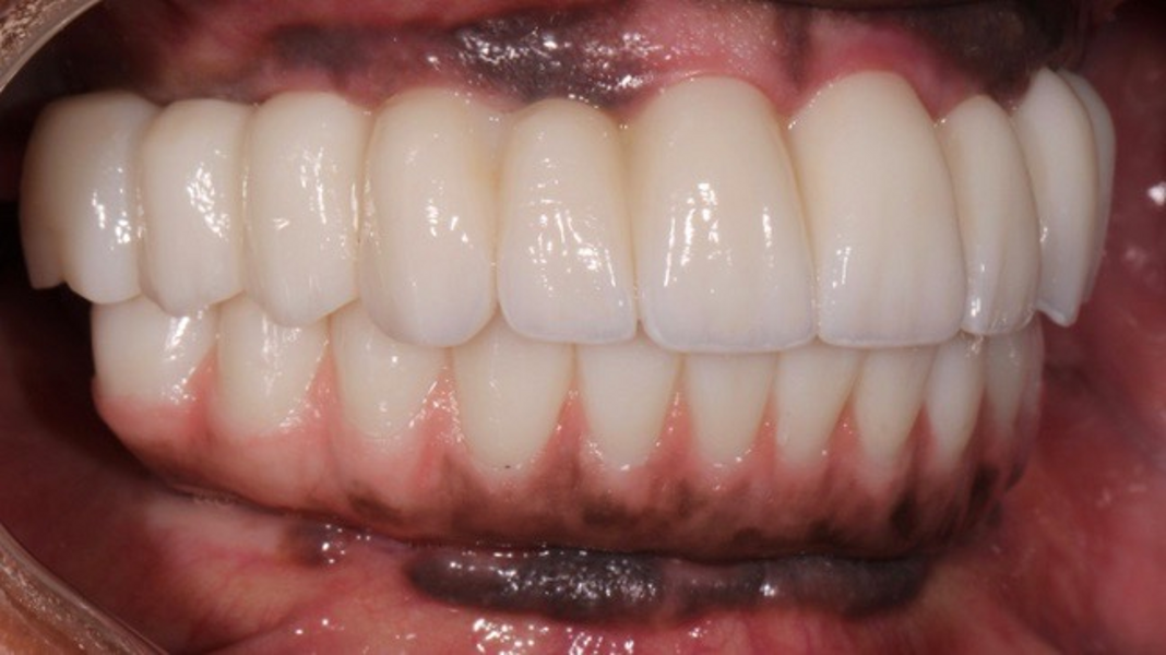 Fig. 31: Right lateral view of the teeth in maximum intercuspation.
