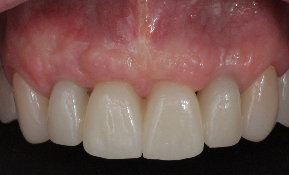 Fig. 18: Frontal aspect of the restorations after the two-year follow-up period.