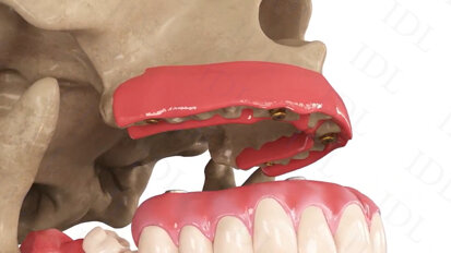 IDL Dental Technologies – Angulated Loc-In Abutment