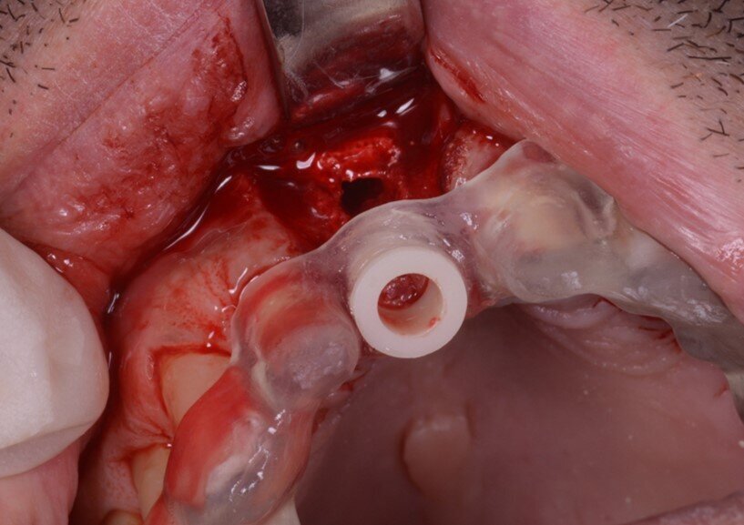 Fig. 17_Le successive frese di preparazione lavorano attraverso dime dedicate.