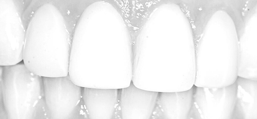 Alba Rohrwacher's teeth before use of the Dentamask.