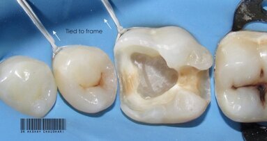 Rubber dam- Ace the basics