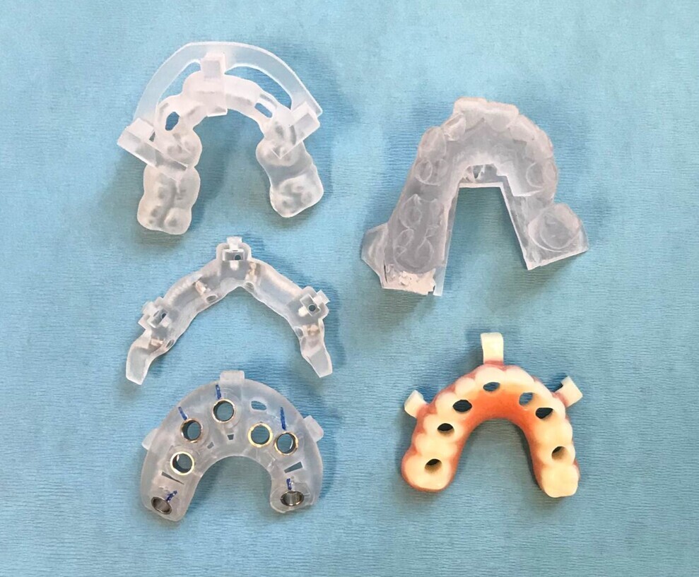 Fig. 5: Surgical guides and provisional restoration.