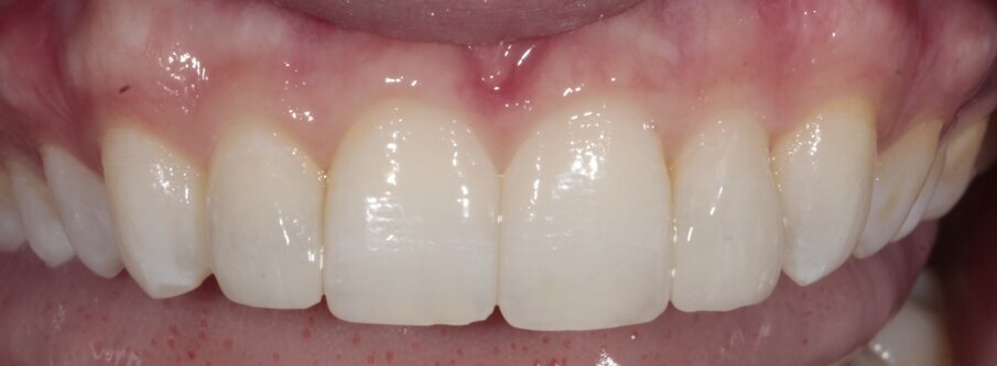 17. Close-up eindsituatie