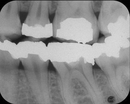 Afb. 1: Bitewing van het tweede en derde kwadrant 